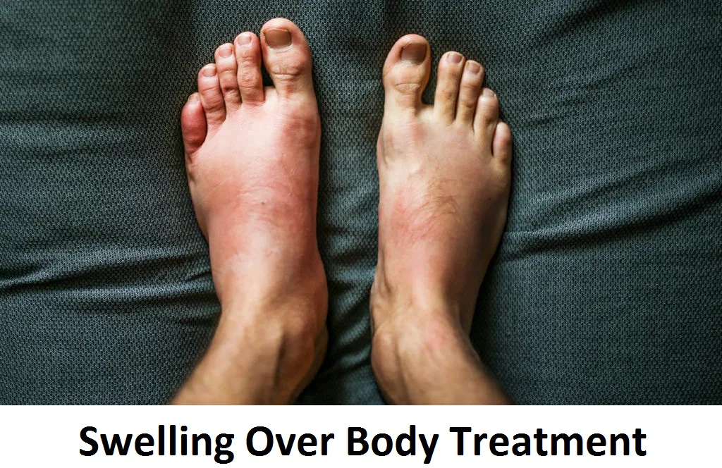 SWELLING OVER BODY TREATMENT